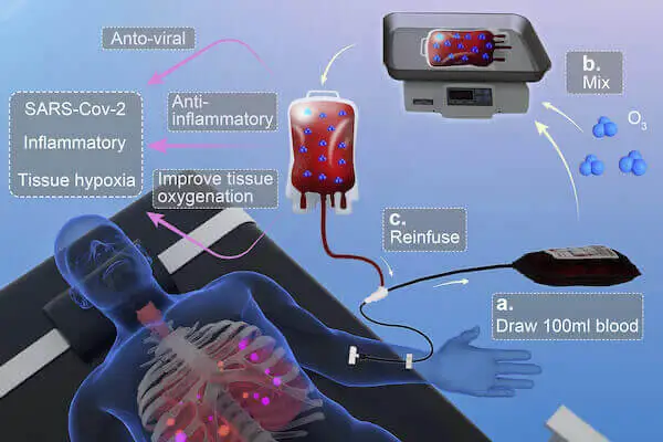 Guarigione di quattro pazienti mediante autoemoinfusione di ozono