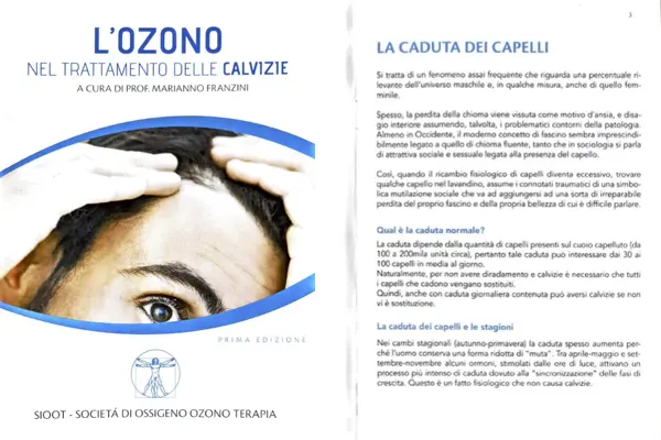 L'ozono nel trattamento delle calvizie